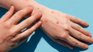 
                        മങ്കിപോക്സ്; രാജ്യത്തെ രണ്ടാമത്തെ രോഗിയും രോഗമുക്തി നേടി