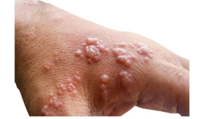 
                        സംസ്ഥാനത്ത് മങ്കി പോക്സ് സ്ഥിരീകരിച്ചു