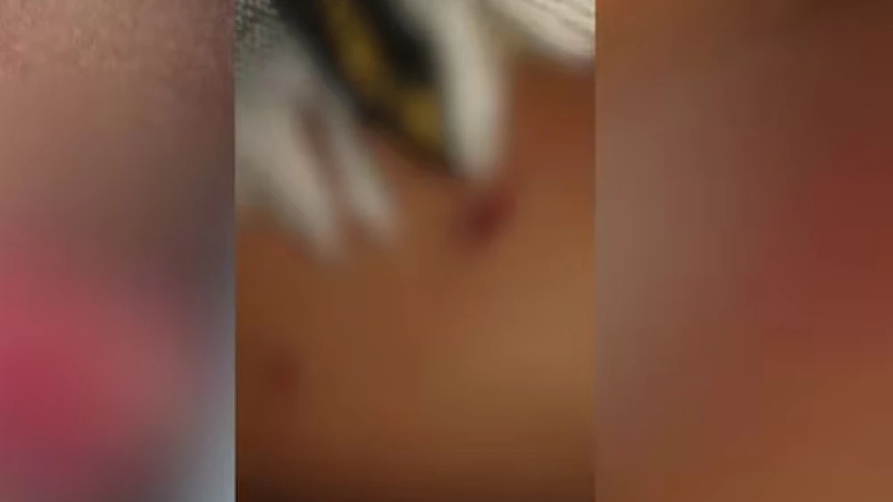  7വയസുകാരനെ തെരുവുനായ്ക്കൾ വളഞ്ഞിട്ട് കടിച്ചുപറിച്ചു, ഗുരുതര പരിക്ക്