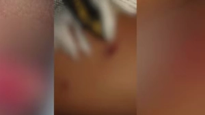 
                        7വയസുകാരനെ തെരുവുനായ്ക്കൾ വളഞ്ഞിട്ട് കടിച്ചുപറിച്ചു, ഗുരുതര പരിക്ക്