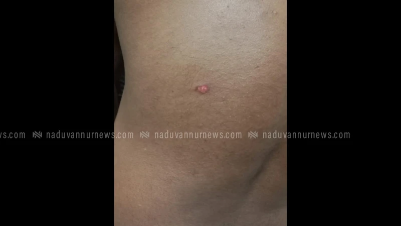 നൊച്ചാട് സ്വദേശിയായ ബൈക്ക് യാത്രികന് സൂര്യാഘാതമേറ്റു