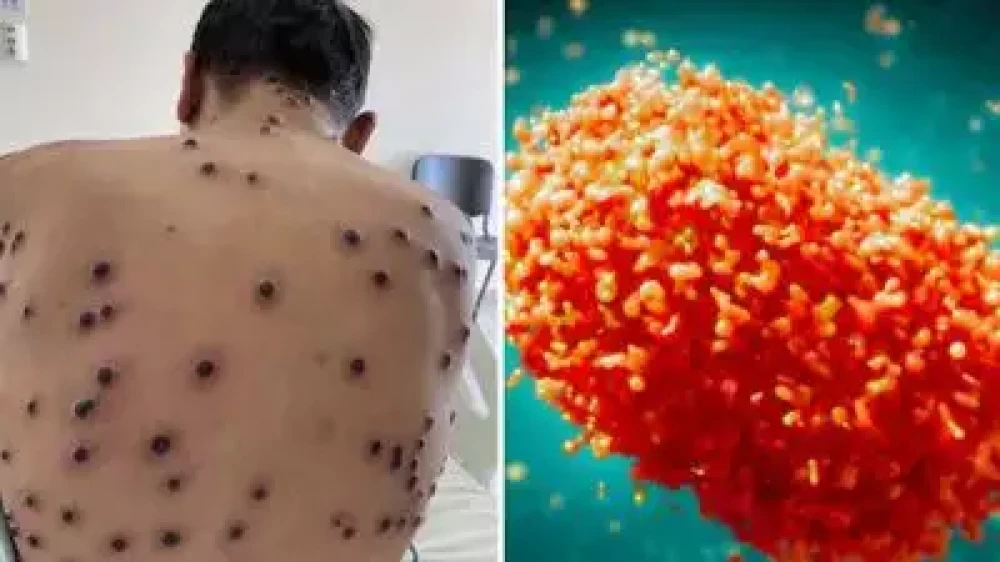 എംപോക്‌സ് രോഗം; ആലപ്പുഴയിലും നിരീക്ഷണത്തിലുണ്ടായിരുന്ന രോഗിയുടെ ആദ്യ ഫലം നെഗറ്റീവ്