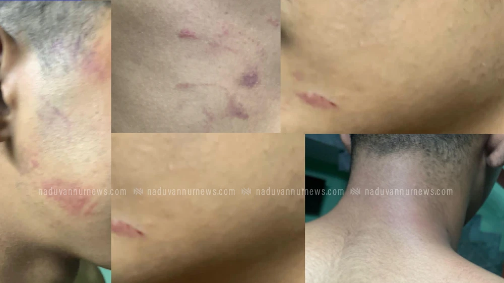 വാകയാട് സ്കൂളിൽ വിദ്യാർത്ഥിയെ മർദ്ദിച്ച 5 സീനിയർ വിദ്യാർത്ഥികളെ സസ്പെൻഡ് ചെയ്തു