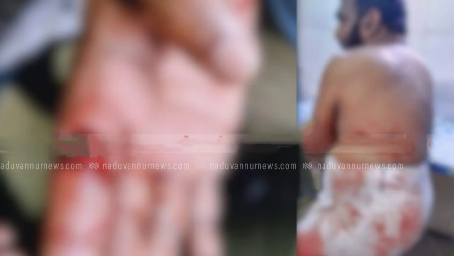  നാദാപുരത്ത് സഹോദരങ്ങളായ രണ്ടുപേർക്ക് വെട്ടേറ്റു