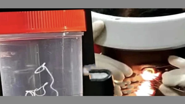  കണ്ണിൽ ചൊറിച്ചിലും അസ്വസ്ഥതയും ; യുവതി യുടെ കണ്ണിൽ നിന്നും പുറത്തെടുത്തത് 10 സെന്റിമീറ്റർ നീളമുള്ള ജീവനുള്ള വിര