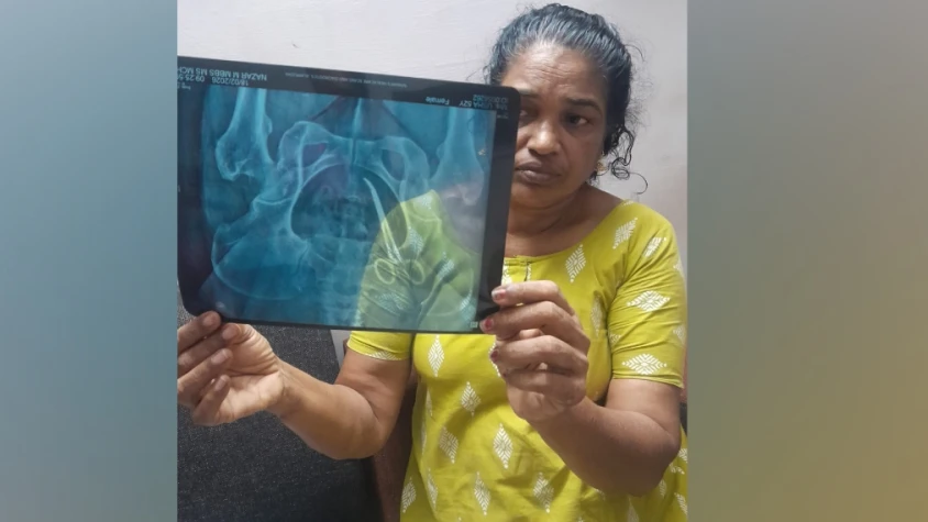 ഓപ്പറേഷൻ സമയത്ത് കത്രിക വയറ്റിൽ മറന്നുവച്ചു; മധ്യവയസ്കക്ക് വയറ്റിൽ കത്രികയുമായി അഞ്ചുവർഷത്തെ ദുരിത ജീവിതം