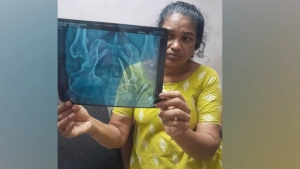 ഓപ്പറേഷൻ സമയത്ത് കത്രിക വയറ്റിൽ മറന്നുവച്ചു; മധ്യവയസ്കക്ക് വയറ്റിൽ കത്രികയുമായി അഞ്ചുവർഷത്തെ ദുരിത ജീവിതം