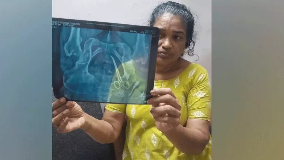 വയറ്റില്‍ കത്രിക കുടുങ്ങിയതില്‍ പിഴവ് സമ്മതിച്ച് ആശുപത്രി അധികൃതര്‍;ഉഷയുടെ ശസ്ത്രക്രിയ നാളെ