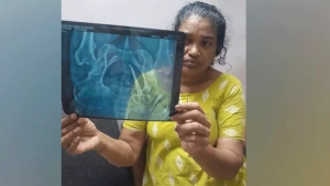 വയറ്റില്‍ കത്രിക കുടുങ്ങിയതില്‍ പിഴവ് സമ്മതിച്ച് ആശുപത്രി അധികൃതര്‍;ഉഷയുടെ ശസ്ത്രക്രിയ നാളെ