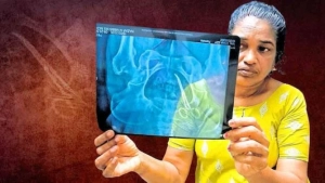 ഉഷ ജോസഫിന്റെ ശസ്ത്രക്രിയ പൂർത്തിയായി; വയറ്റിൽ കുടുങ്ങിയിരുന്ന കത്രിക പുറത്തെടുത്തു