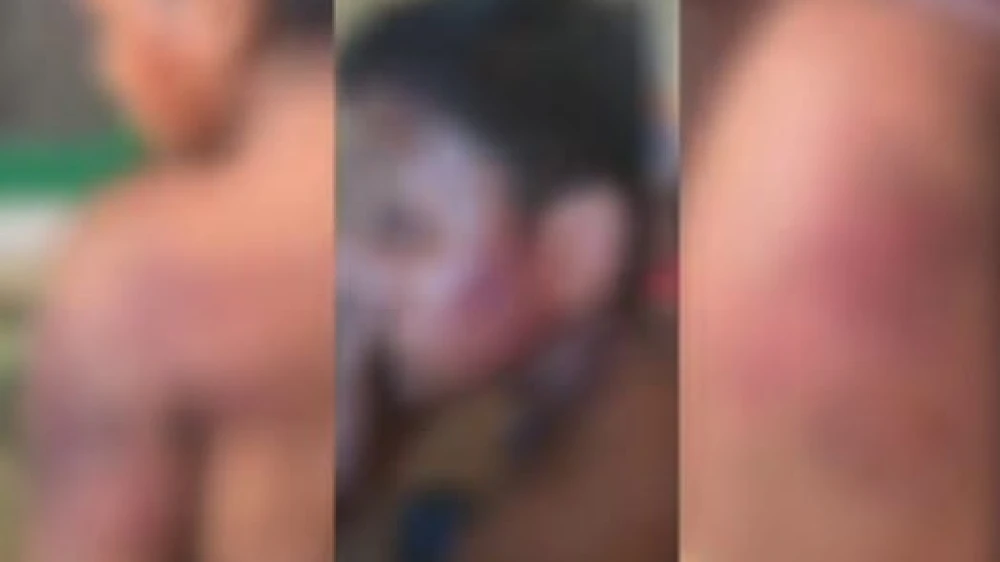  മോഷണക്കുറ്റം ആരോപിച്ച് ഭിന്നശേഷിക്കാരനായ യുവാവിനെ ക്രൂരമായി മർദിച്ചു