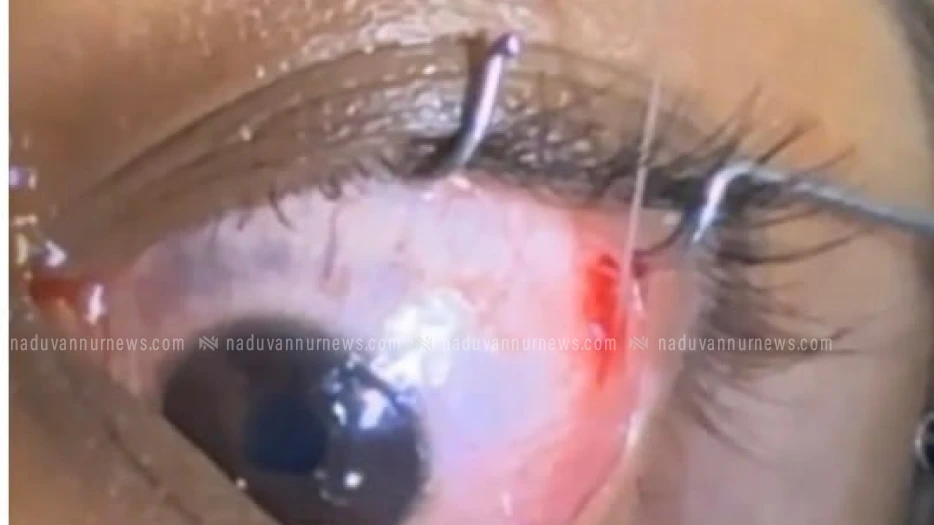  മൊടക്കല്ലൂർ ആശുപത്രിയിൽ പേരാമ്പ്ര സ്വദേശിയുടെ കണ്ണിൽ നിന്നും ശസ്ത്രക്രിയയിൽ വിരയെ പുറത്തെടുത്തു