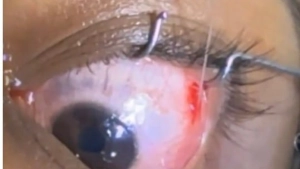 മൊടക്കല്ലൂർ ആശുപത്രിയിൽ പേരാമ്പ്ര സ്വദേശിയുടെ കണ്ണിൽ നിന്നും ശസ്ത്രക്രിയയിൽ വിരയെ പുറത്തെടുത്തു