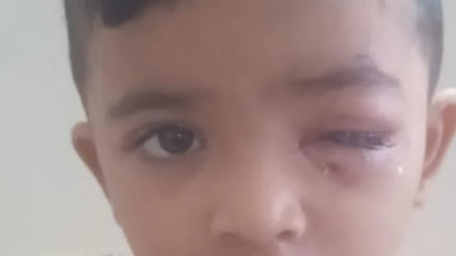 തെരുവുനായ ആക്രമണം രണ്ടര വയസ്സുകാരന് പരിക്ക്