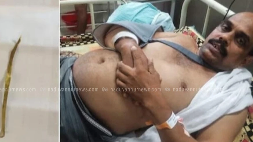  ചികിത്സ പിഴവ്: കോട്ടൂർ സ്വദേശിയുടെ ശരീരത്തിൽ നിന്ന് പുറത്തെടുത്തത് 5 സെൻറീമീറ്റർ നീളമുള്ള മരക്കഷണങ്ങൾ