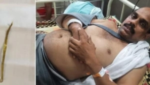 ചികിത്സ പിഴവ്: കോട്ടൂർ സ്വദേശിയുടെ ശരീരത്തിൽ നിന്ന് പുറത്തെടുത്തത് 5 സെൻറീമീറ്റർ നീളമുള്ള മരക്കഷണങ്ങൾ